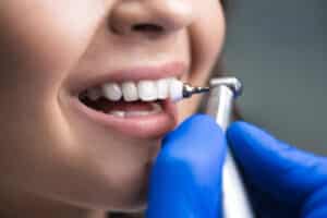 Does Teeth Cleaning Remove Stains from the Teeth